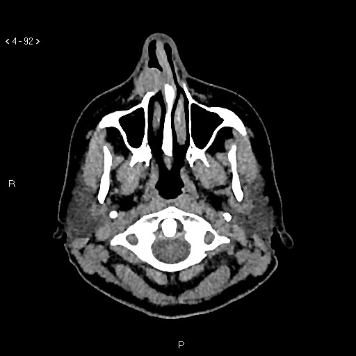 Nasolabial cyst (Radiopaedia 75125-86194 Axial non-contrast 54).jpg
