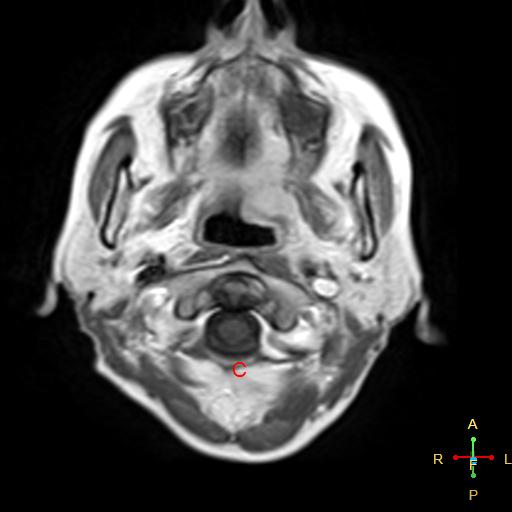 File:Nasopharyngeal carcinoma infiltrating the clivus (Radiopaedia 25229-25481 Axial T1 C+ 2).jpg