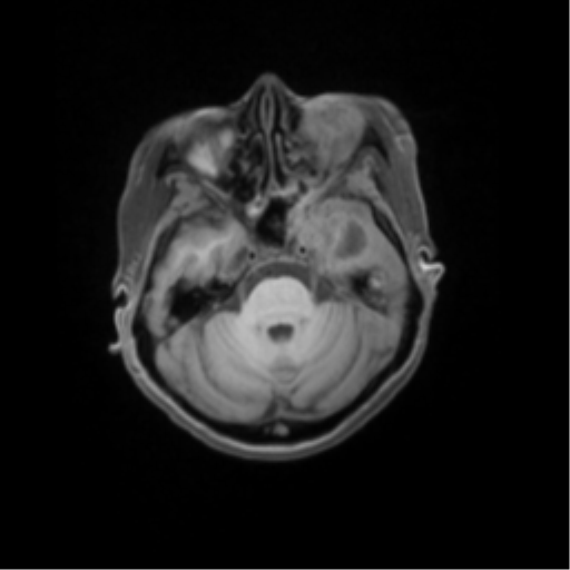 File:Nasopharyngeal carcinoma with cerebral abscess (Radiopaedia 43018-46274 Axial T1 fat sat 17).png