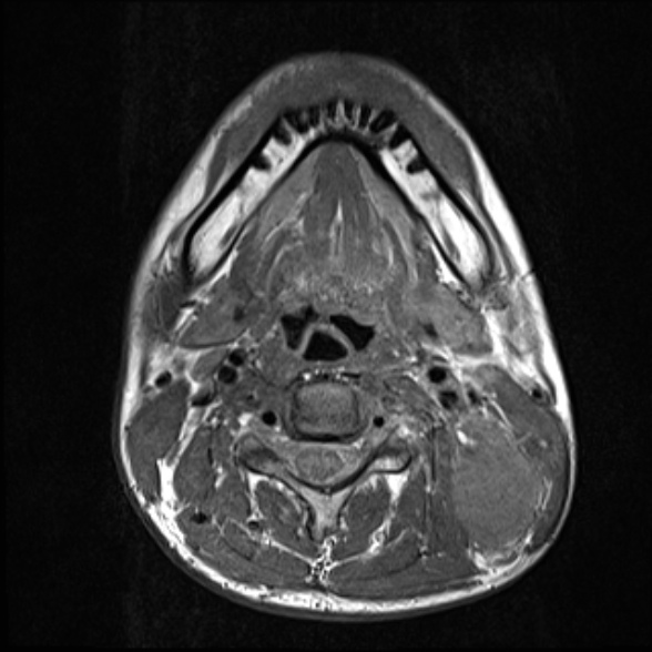 File:Nasopharyngeal carcinoma with skull base invasion (Radiopaedia 53415-59485 Axial T1 47).jpg