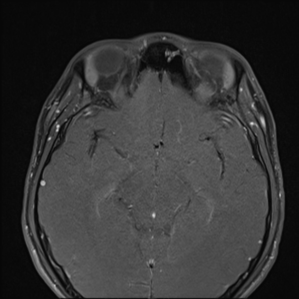 File:Nasopharyngeal carcinoma with skull base invasion (Radiopaedia 53415-59485 Axial T1 C+ fat sat 12).jpg