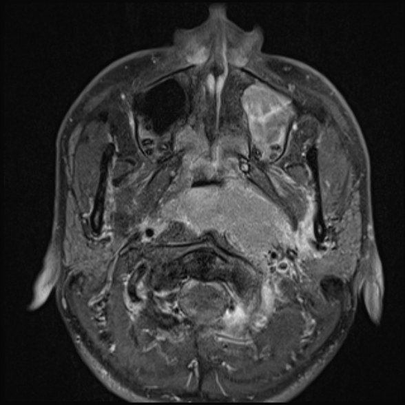 File:Nasopharyngeal carcinoma with skull base invasion (Radiopaedia 53415-59485 Axial T1 C+ fat sat 31).jpg