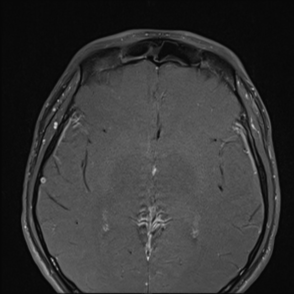 Nasopharyngeal carcinoma with skull base invasion (Radiopaedia 53415-59485 Axial T1 C+ fat sat 9).jpg