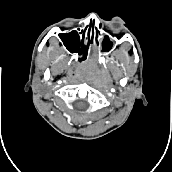Nasopharyngeal carcinoma with skull base invasion (Radiopaedia 53415-59705 A 45).jpg