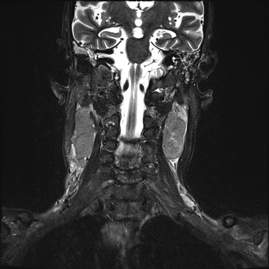 Nasopharyngeal carcinoma with skull base invasion (Radiopaedia 59258-66600 Coronal T2 fat sat 10).jpg
