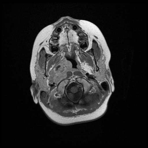 File:Nasopharyngeal rhabdomyosarcoma (Radiopaedia 23417-23486 Axial T1 C+ 2).jpg
