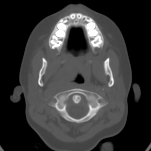 File:Nasopharyngeal rhabdomyosarcoma (Radiopaedia 23417-23491 Axial bone window 1).jpg