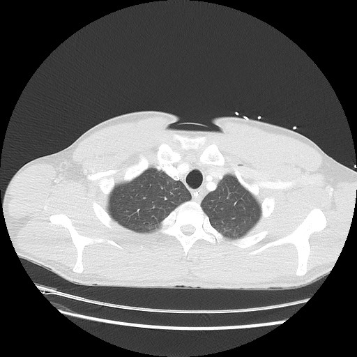 Near-drowning pulmonary edema (Radiopaedia 59457-66814 Axial lung window 7).jpg