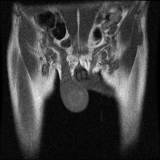 File:Necrotizing epididymo-orchitis with intra-testicular abscess (Radiopaedia 29397-29860 Coronal T1 6).jpg