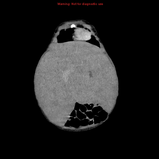 File:Neonatal neuroblastoma (Radiopaedia 9564-10223 B 30).jpg