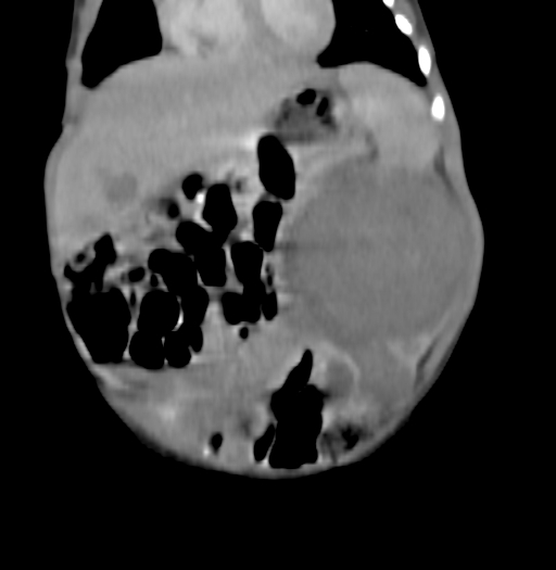 Nephroblastomatosis (Radiopaedia 71294-81607 B 118).jpg