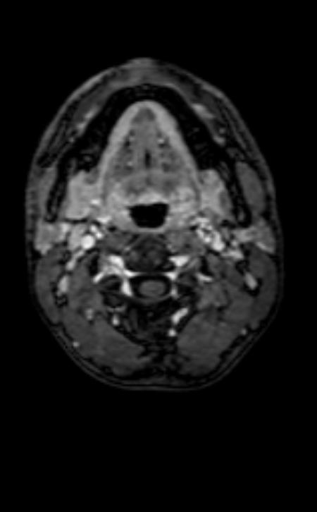 Neuro-Behçet disease (Radiopaedia 90112-107294 Axial T1 C+ 240).jpg