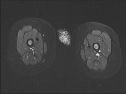 File:Neuroblastoma with bone metastases (Radiopaedia 67080-76414 Axial STIR 28).jpg