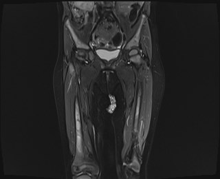 File:Neuroblastoma with bone metastases (Radiopaedia 67080-76414 Coronal STIR 10).jpg