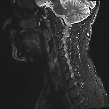 File:Neurofibromatosis type 1 (Radiopaedia 80355-93740 Sagittal STIR 8).jpg