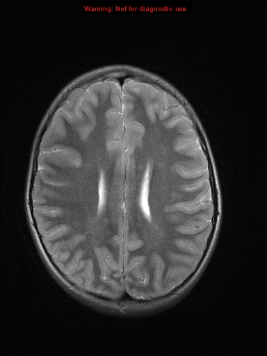 File:Neurofibromatosis type 1 with optic nerve glioma (Radiopaedia 16288-15965 Axial T2 9).jpg