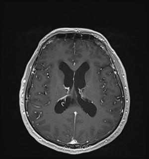 Neurofibromatosis type 2 (Radiopaedia 79097-92049 Axial T1 C+ 115).jpg
