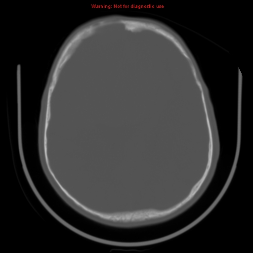 File:Neurofibromatosis type 2 (Radiopaedia 8953-9732 Axial bone window 23).jpg