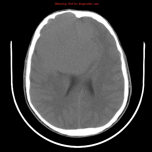 File:Neurofibromatosis type 2 (Radiopaedia 8953-9732 Axial non-contrast 22).jpg