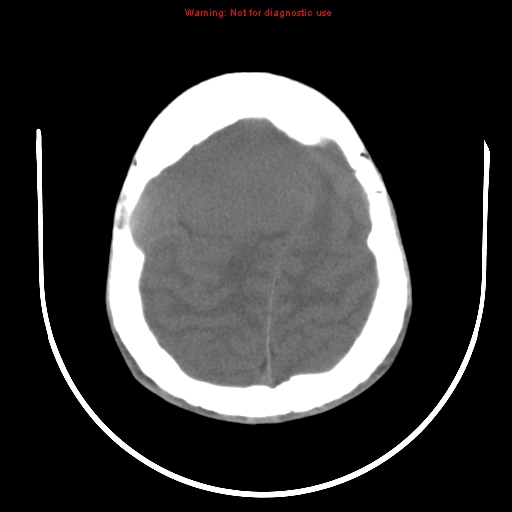 File:Neurofibromatosis type 2 (Radiopaedia 8953-9732 Axial non-contrast 27).jpg