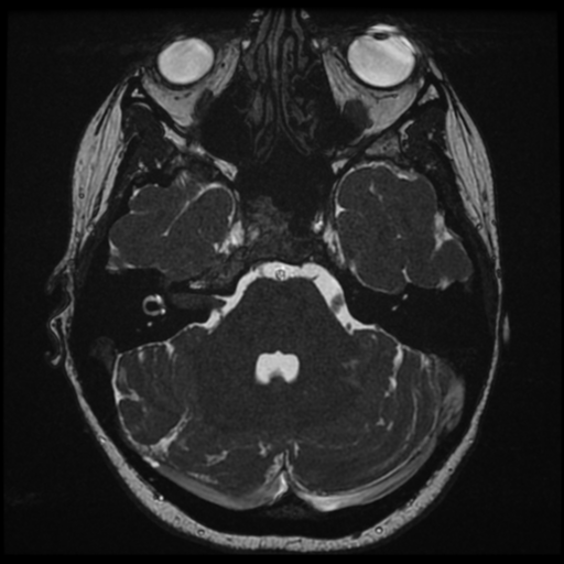 File:Neurofibromatosis type 2 - bilateral acoustic neuromata (Radiopaedia 40060-42566 Axial FIESTA 46).png