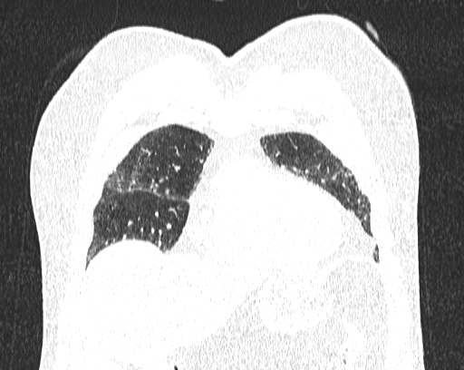 Non-specific interstitial pneumonia (NSIP) (Radiopaedia 68599-78228 Coronal lung window 16).jpg