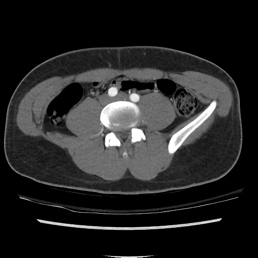 File:Normal CT angiogram of pelvis (Radiopaedia 45390-49430 A 18).jpg