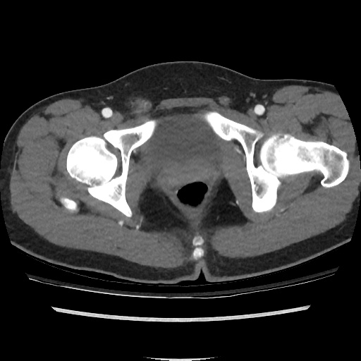 File:Normal CT angiogram of pelvis (Radiopaedia 45390-49430 A 49).jpg