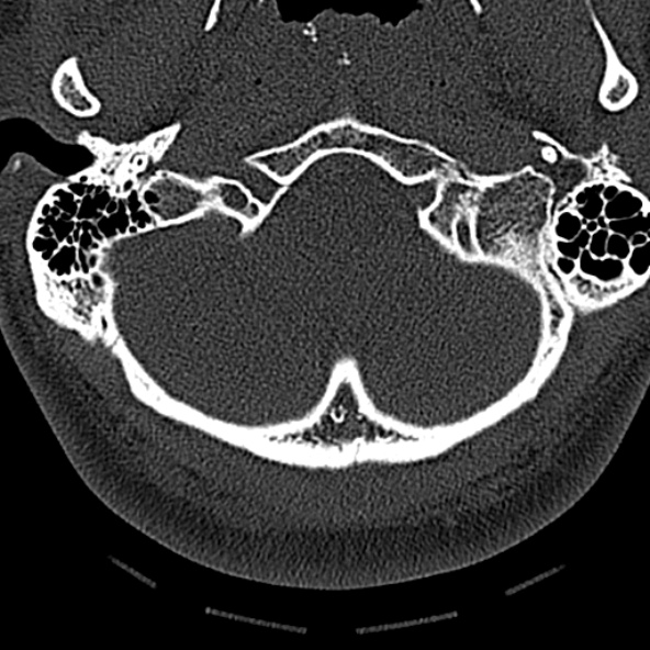 Normal CT of the cervical spine (Radiopaedia 53322-59305 Axial bone window 31).jpg