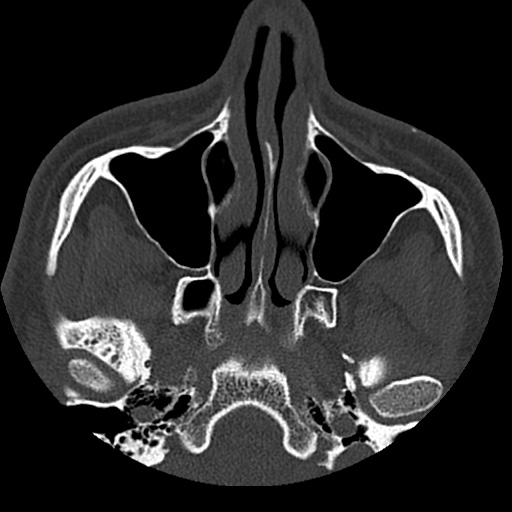 Normal CT paranasal sinuses (Radiopaedia 42286-45390 Axial bone window 75).jpg