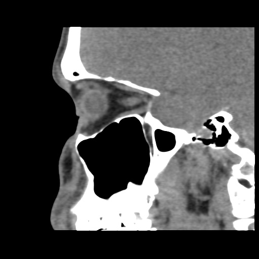Normal CT paranasal sinuses (Radiopaedia 42286-45390 F 56).jpg