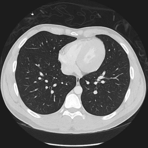 Normal CT pulmonary veins (pre RF ablation) (Radiopaedia 41748-44702 Axial lung window 39).png