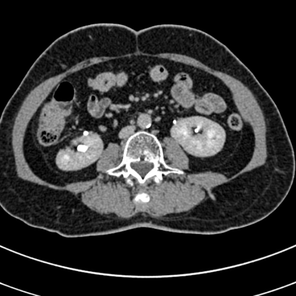 File:Normal CT split bolus study of the renal tract (Radiopaedia 48631-53634 Axial split bolus 129).jpg