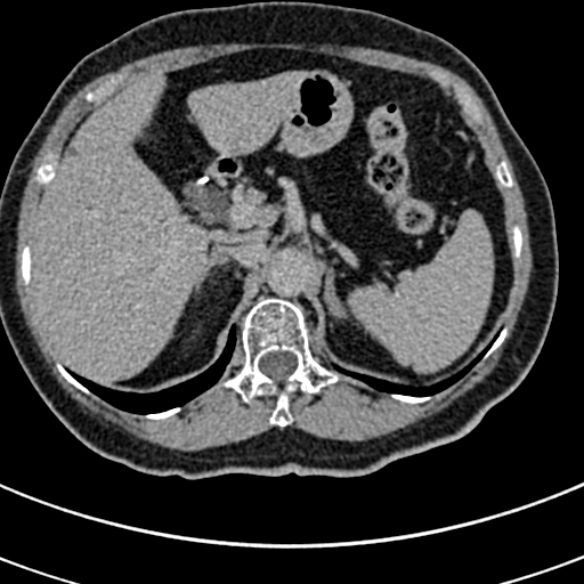 File:Normal CT split bolus study of the renal tract (Radiopaedia 48631-53634 Axial split bolus 18).jpg