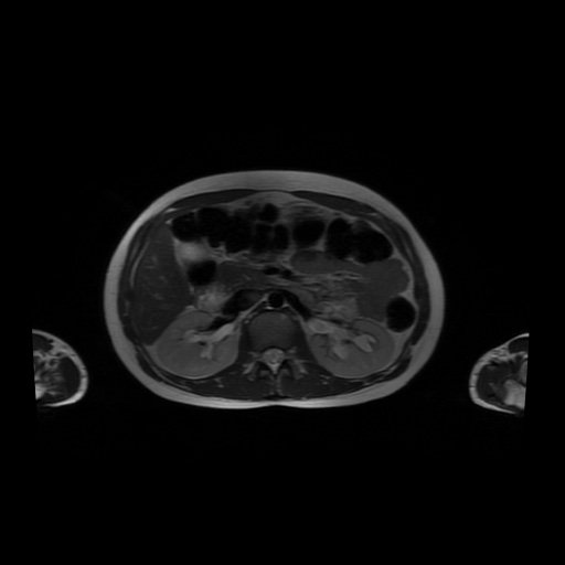 File:Normal MRI abdomen in pregnancy (Radiopaedia 88001-104541 Axial T2 22).jpg