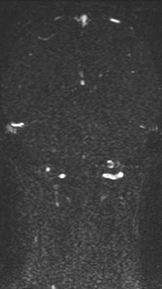 Normal MRI brain with MRV- teenager (Radiopaedia 49425-54553 Coronal MRV 172).jpg