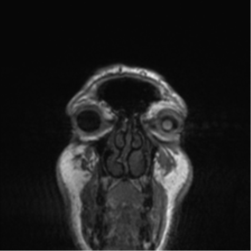Normal brain MRI (non-focal epilepsy protocol) (Radiopaedia 53917-60040 Coronal T1 63).png