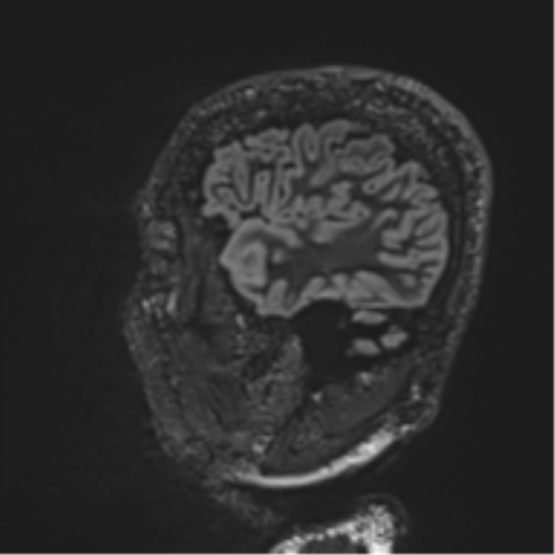 Normal brain MRI (non-focal epilepsy protocol) (Radiopaedia 53917-60040 Sagittal DIR 15).png