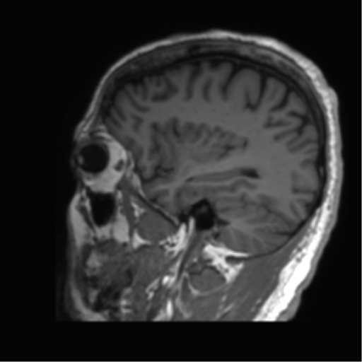 Normal brain MRI (non-focal epilepsy protocol) (Radiopaedia 53917-60040 Sagittal T1 51).png