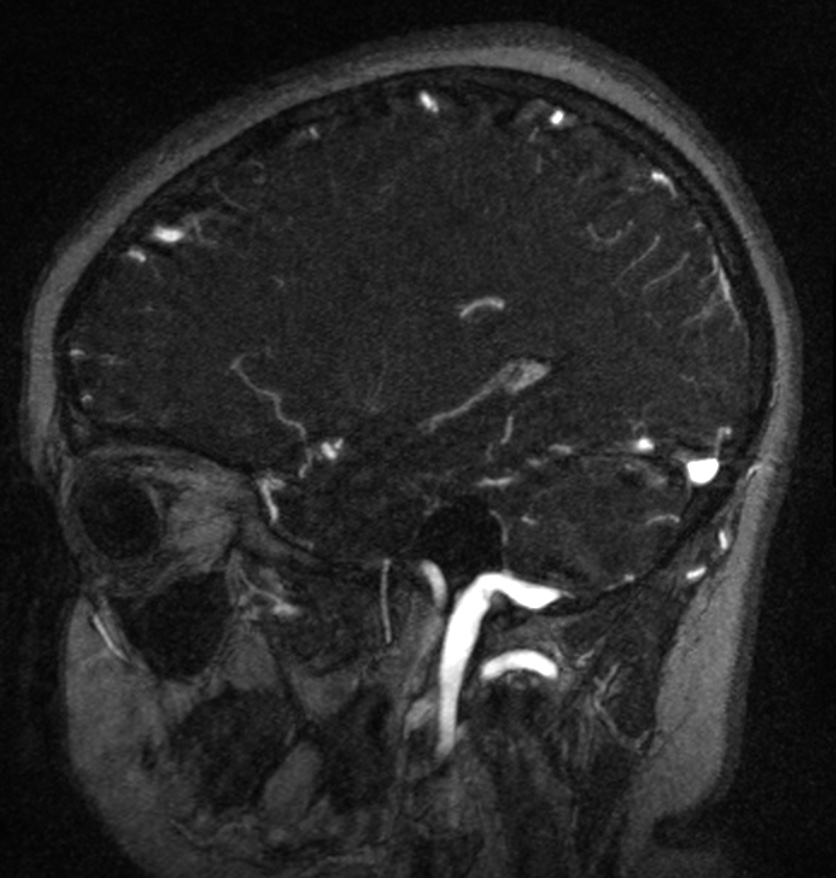 Normal brain MRI and venogram (Radiopaedia 39554-41862 Sagittal MRV 19).jpg