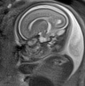 Normal brain fetal MRI - 22 weeks (Radiopaedia 50623-56050 Sagittal T2 Haste 15).jpg