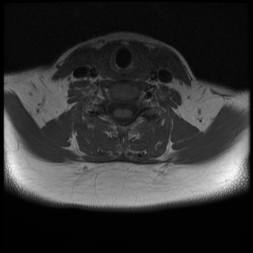 File:Normal cervical and thoracic spine MRI (Radiopaedia 35630-37156 Axial T1 13).png