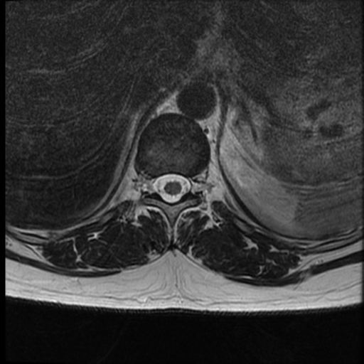 File:Normal cervical and thoracic spine MRI (Radiopaedia 35630-37156 H 11).png