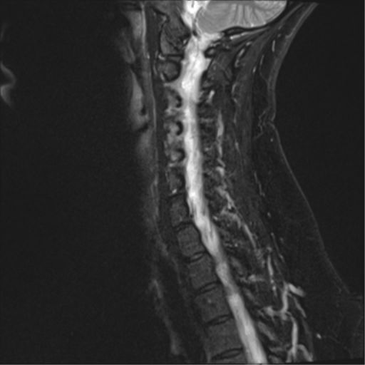 File:Normal cervical spine MRI (including Dixon) (Radiopaedia 42762-45925 Dixon- Water 11).png