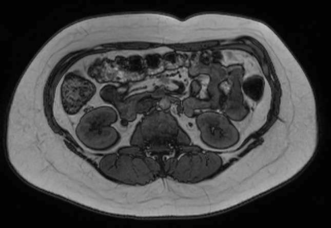 File:Normal liver MRI with Gadolinium (Radiopaedia 58913-66163 B 10).jpg