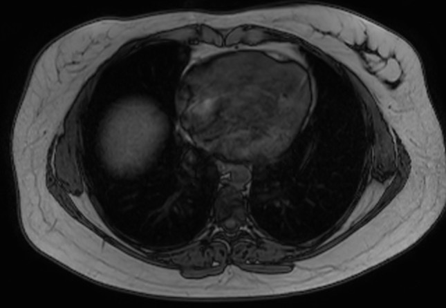 File:Normal liver MRI with Gadolinium (Radiopaedia 58913-66163 B 32).jpg