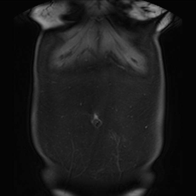 Normal liver MRI with Gadolinium (Radiopaedia 58913-66163 P 9).jpg