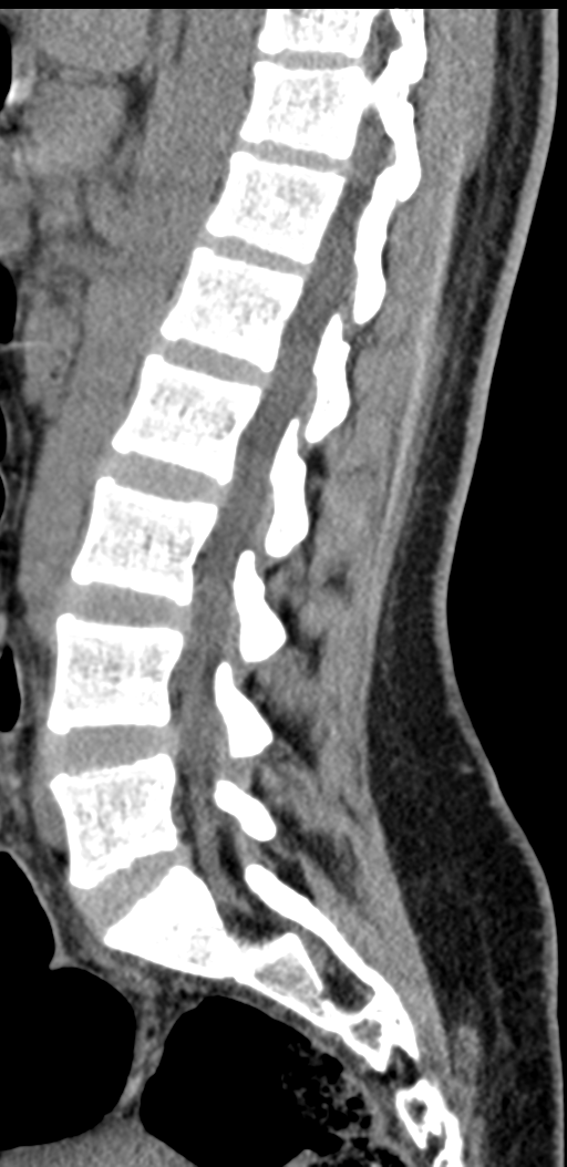 Normal lumbosacral CT (Radiopaedia 37923-39867 E 51).png