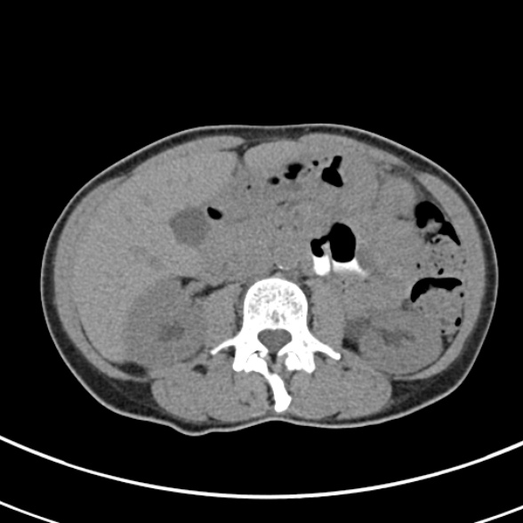 File:Normal multiphase CT liver (Radiopaedia 38026-39996 Axial non-contrast 34).jpg
