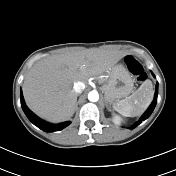 File:Normal multiphase CT liver (Radiopaedia 38026-39996 B 16).jpg